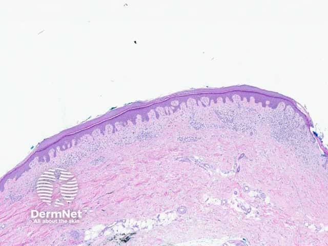 Figure 6: macular pattern