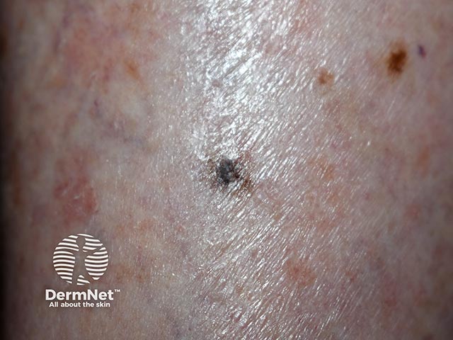 A biopsy-confirmed solar lentigo on the leg