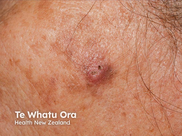 Squamous cell carcinoma on the cheek