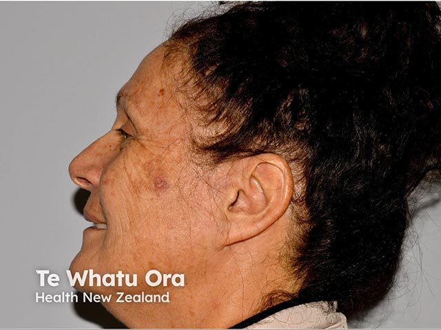 Cutaneous squamous cell carcinoma on the zygoma in skin of colour