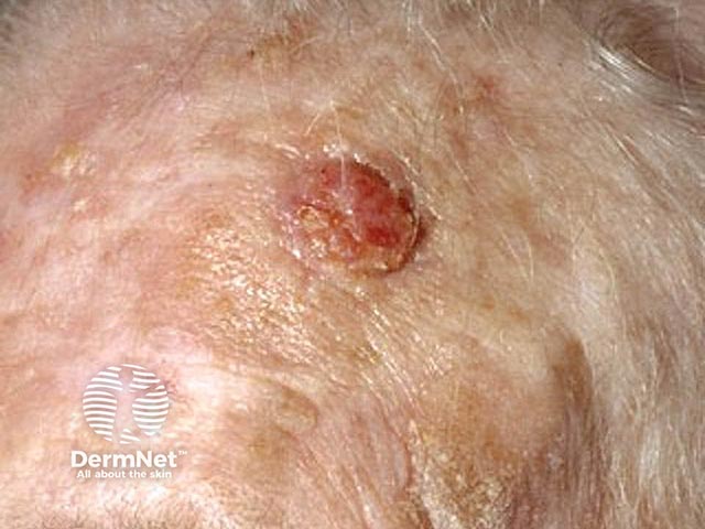 Scalp squamous cell carcinoma