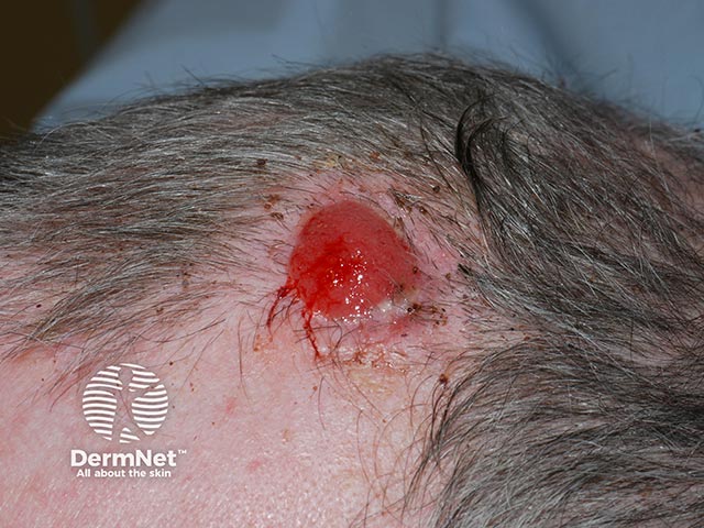 An ulcerated squamous cell carcinoma on the anterior scalp