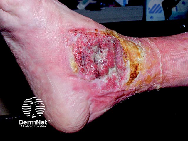 A squamous cell carcinoma has arisen within a longstanding venous ulcer