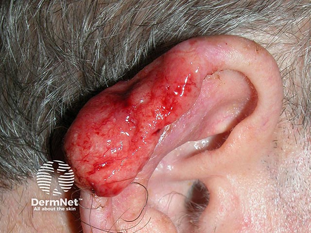 A bleeding and ulcerated poorly-differentiated squamous cell carcinoma on the ear