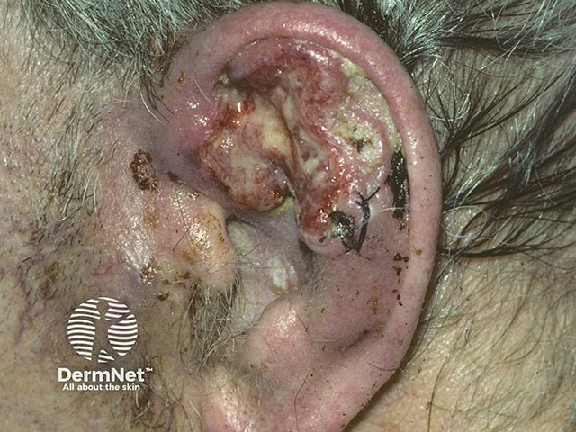 An ulcerated squamous cell carcinoma on the ear; there is enlargement of the pre-auricular lymph node due to spread of the tumour