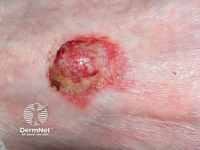 An ulcerated haemorrhagic squamous cell carcinoma on the foot