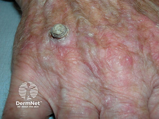 A grossly hyperkeratotic well-differentiated squamous cell carcinoma on the back of a farmer's hand