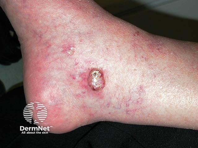 A hyperkeratotic squamous cell carcinoma on the ankle