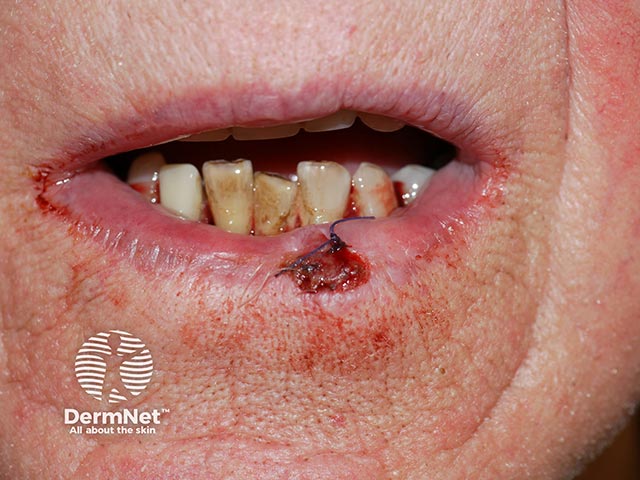 An ulcerated and firm lesion on the lip - the patient was a smoker and the lesion was a squamous cell carcinoma