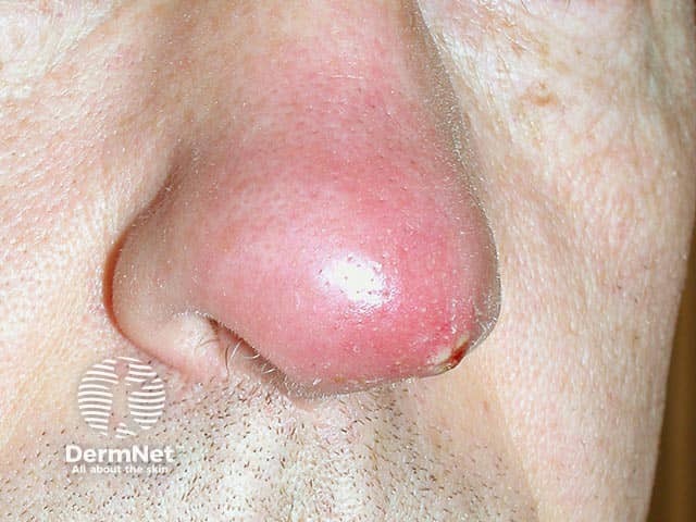 A nasal furuncle due to a PVL Staphylococcus