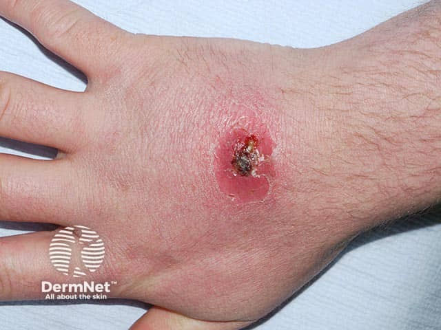 A PVL staphylococcal infection on the dorsal hand