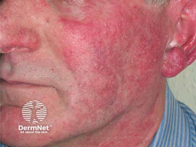 Steroid induced papulopustular rosacea