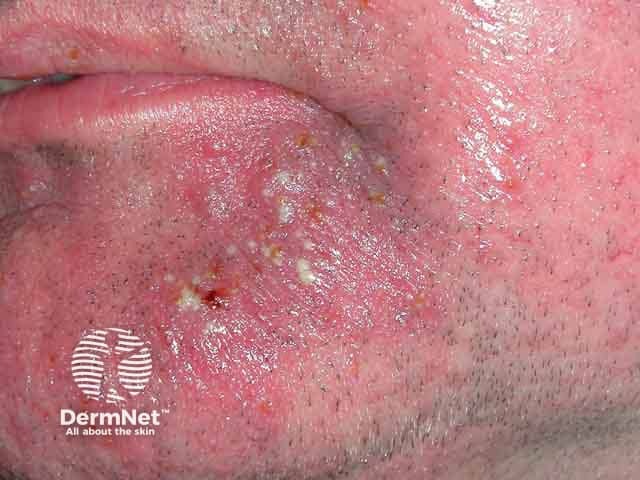 Steroid induced papulopustular rosacea on the chin