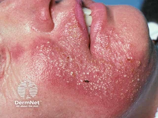 Steroid induced rosacea on the face.