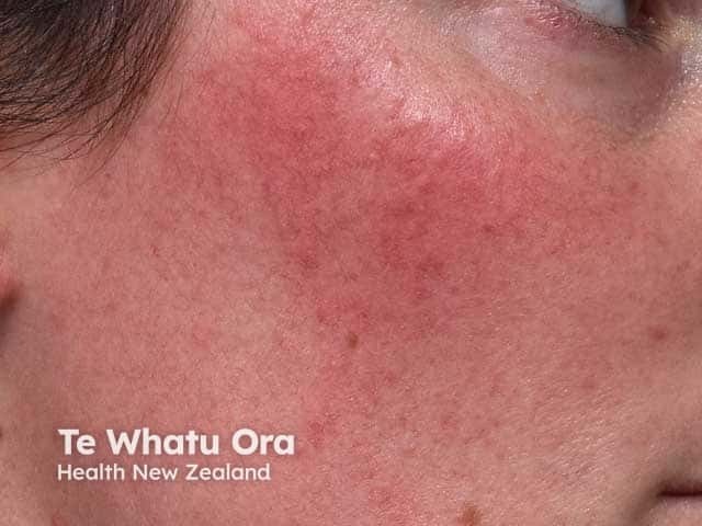 Steroid induced erythematotelangiectatic cheek rosacea