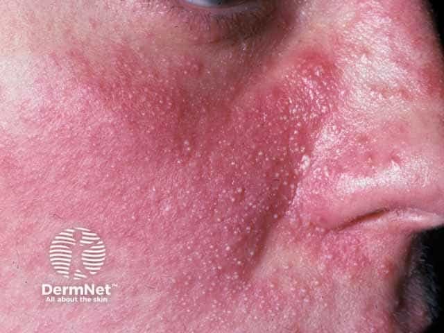 Steroid induced papulopustular rosacea