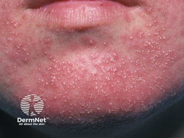 Steroid induced papulopustular rosacea