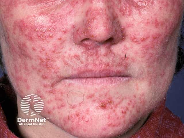 Steroid induced facial rosacea