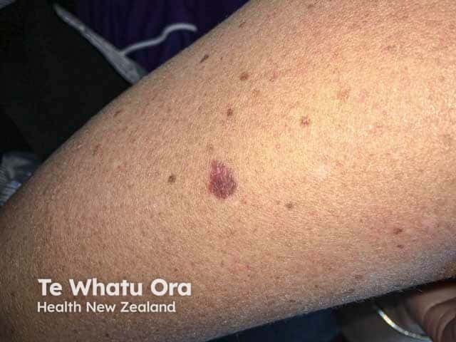 An ugly duckling pigmented lesion on the arm - a superficial spreading malignant melanoma