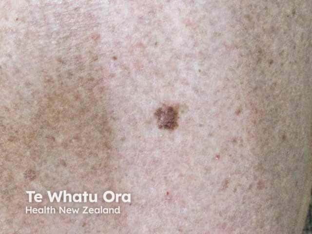 Irregular edge, asymmetry and irregular pigmentation of a melanoma on the back