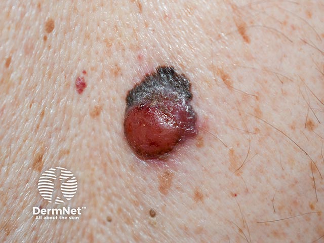 An amelanotic nodular melanoma arising within a superficial spreading melanoma on the back