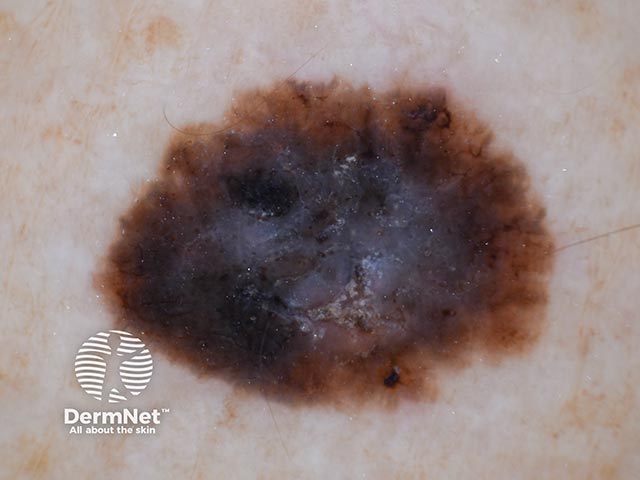 Dermoscopic image of a superficial spreading melanoma on the forearm