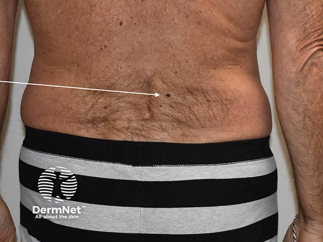 A melanoma in situ on the lower back