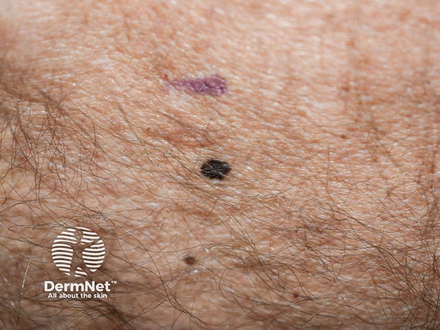 A melanoma in situ on the lower back - dark brown and black in colour with irregularity and notching of the border