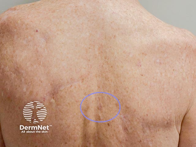 A hypomelanotic macule on the mid back - excision showed a thin superficial spreading melanoma