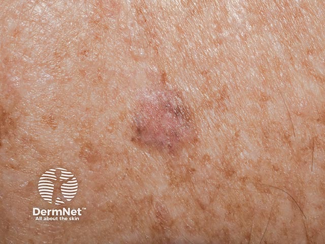 Close-up of a hypomelanotic thin superficial spreading melanoma on the back