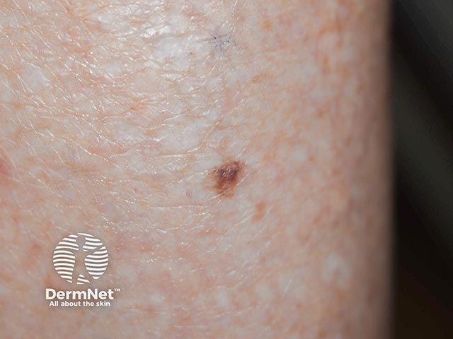 A changing irregularly-pigmented lesion on the ankle - an in situ melanoma