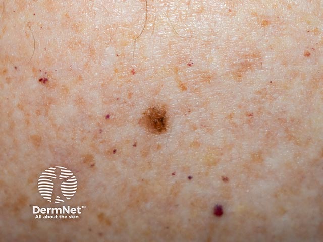 A superficial spreading melanoma on the back in a patient with a personal history of melanoma