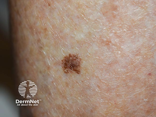 A thin invasive melanoma arising within an in situ lesion on the calf - note the irregular edge and notch