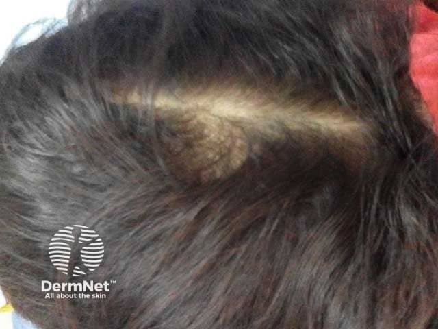 Clinical image of a female patient with diffuse shedding of hair.