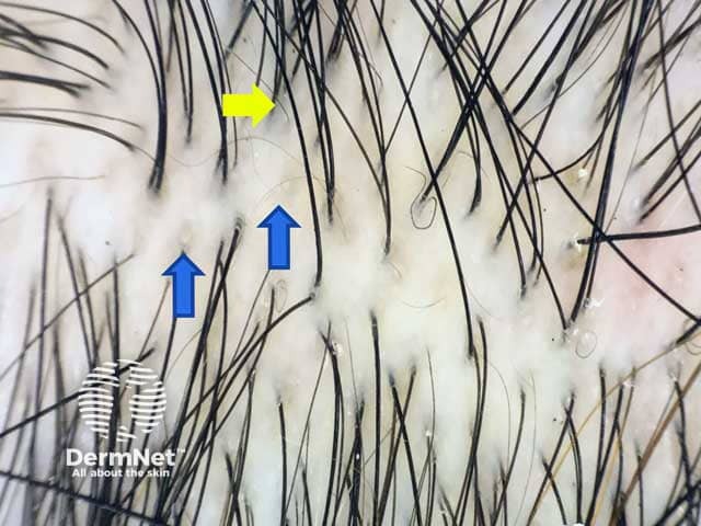 Dermoscopic image showing yellow dots representing the empty follicles (blue arrows) and upright re-growing hairs (yellow arrow) all over the scalp denoting telogen effluvium.