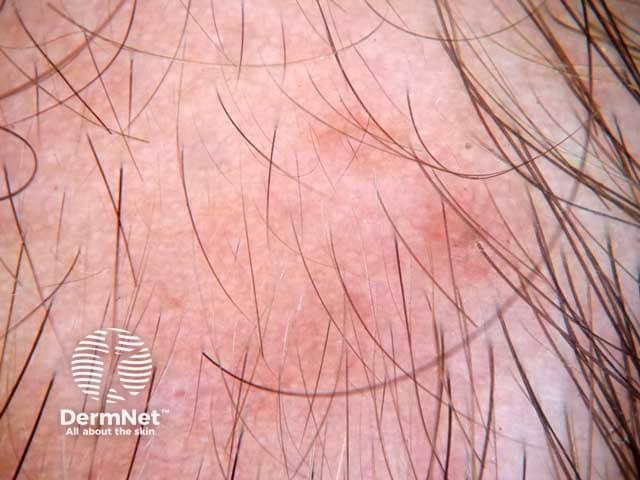 Normal follicular openings with vellus hairs coveirng an area of triangular temporal alopecia.