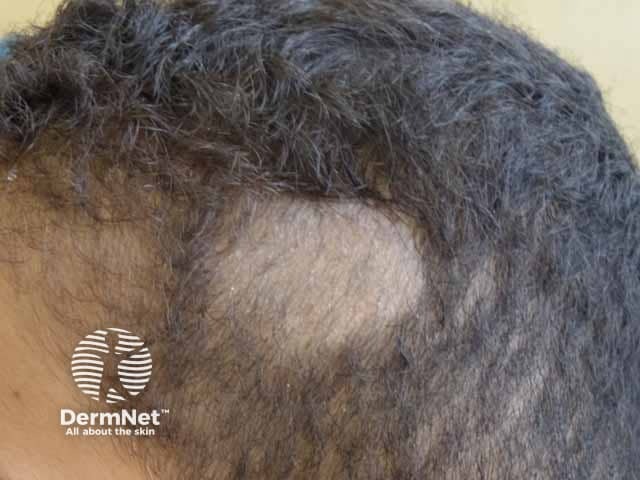 A scaly patch with short broken hairs in tinea capitis