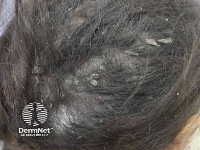 Marked scaling and scalp hair thinning in tinea capitis