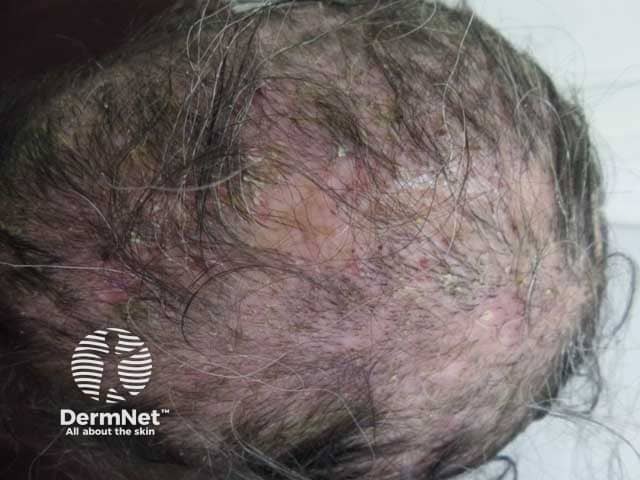 A woman with tinea capitis presenting with diffuse hair loss and scalp scaling