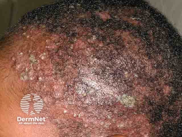 Scale, pustules and patchy hair loss in tinea capitis