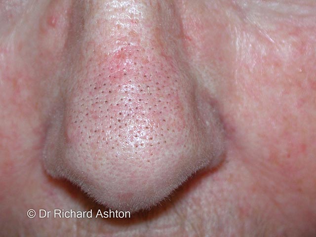 Trichostasis spinulosa causing comedo-like lesions on the nose