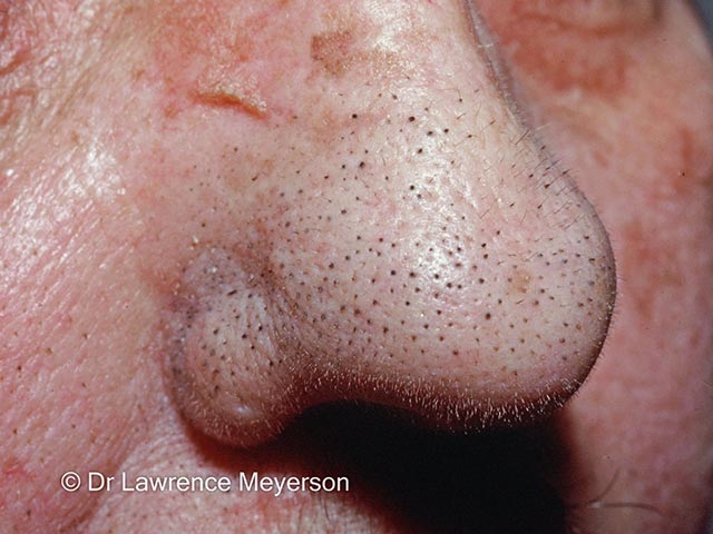 Trichostasis spinulosa on the nose - multiple hairs emanate from a single follicle