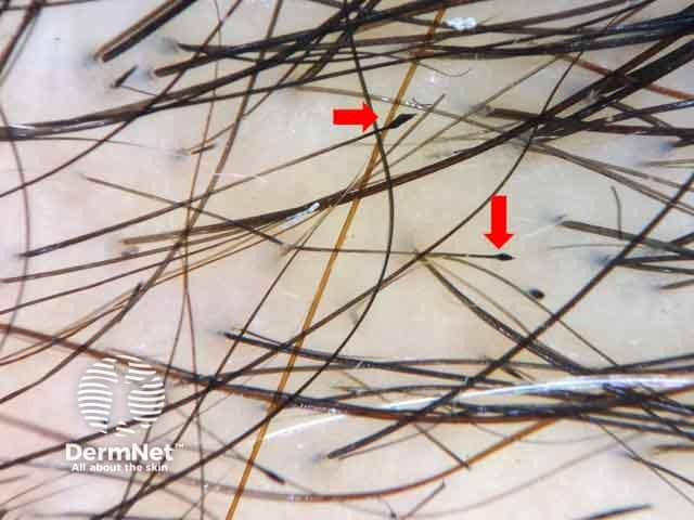 Dermoscopic image of trichotillomania showing tulip hair; hair shaft with darker distal end