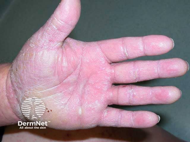 Lichen planus over the palm producing a keratoderma