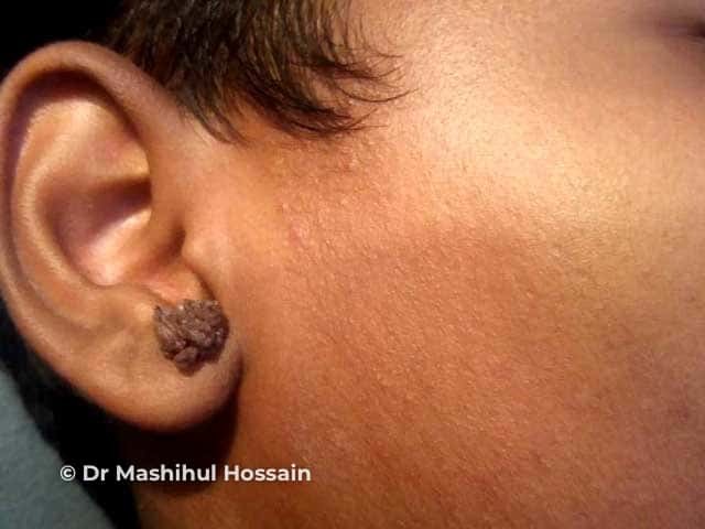 Viral wart: earlobe