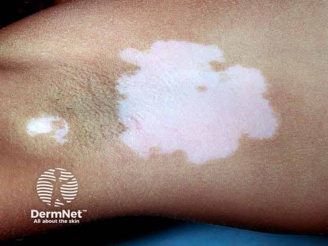 Vitiligo in the axilla