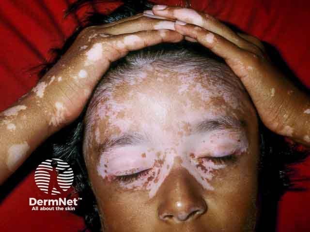 Extensive vitiligo on the lids, face and hands