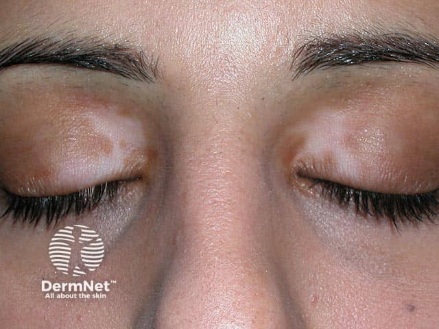 Vitiligo affecting the upper and lower lids symmetrically