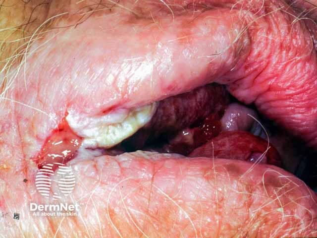 Ulcerated vulval squamous cell carcinoma arising within lichen sclerosus