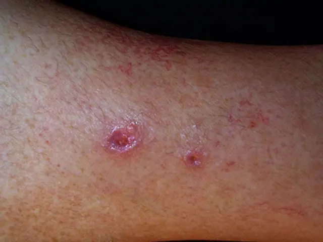 Leg ulcer images